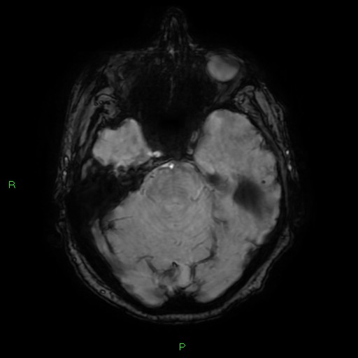 File:Cerebral amyloid angiopathy-associated lobar intracerebral hemorrhage (Radiopaedia 58376-65512 Axial SWI 20).jpg