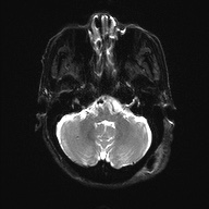 Cerebral amyloid angiopathy-related inflammation (Radiopaedia 74836-85849 Axial DWI 7).jpg