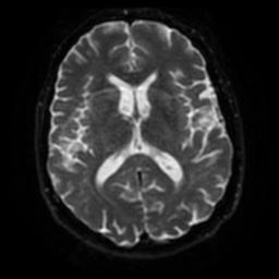 Cerebral amyloid angiopathy (Radiopaedia 28698-28978 Axial DWI 44).jpg
