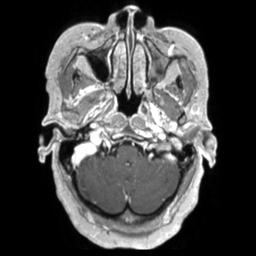 Cerebral amyloid angiopathy (Radiopaedia 29129-29518 Axial T1 C+ 27).jpg