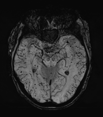 Cerebral amyloid angiopathy (Radiopaedia 46082-50433 Axial SWI MIP 31).png