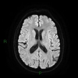 File:Cerebral amyloid angiopathy (Radiopaedia 77506-89664 Axial DWI 17).jpg