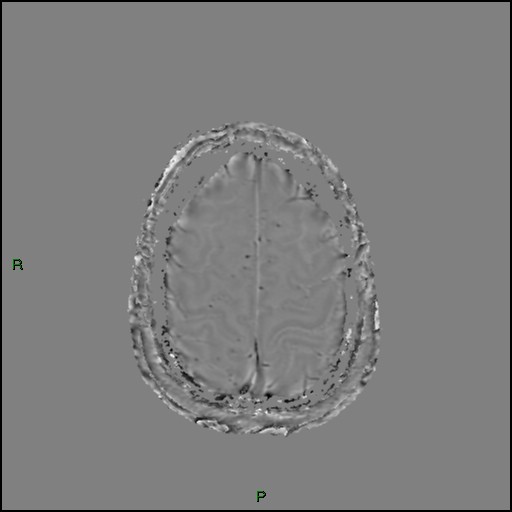 Cerebral amyloid angiopathy (Radiopaedia 77506-89664 H 88).jpg