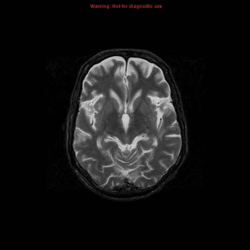 File:Cerebral and orbital tuberculomas (Radiopaedia 13308-13311 Axial T2 10).jpg
