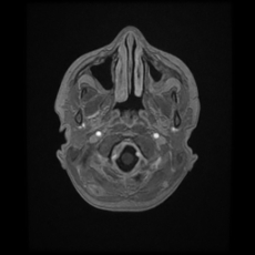 Cerebral and spinal tuberculosis (Radiopaedia 90489-107837 Axial T1 C+ 31).jpg