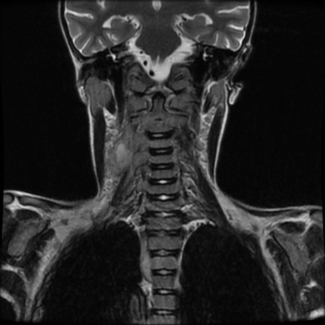 File:Cerebral and spinal tuberculosis (Radiopaedia 90489-107838 Coronal 10).jpg