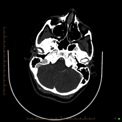 Cerebral arteriovenous malformation (AVM) (Radiopaedia 78162-90706 Axial CTA 72).jpg