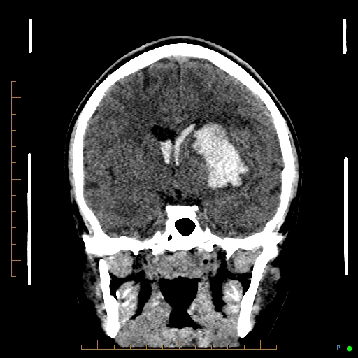 Cerebral arteriovenous malformation (AVM) (Radiopaedia 78162-90706 Coronal non-contrast 45).jpg