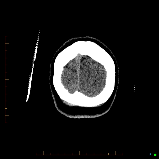 Cerebral arteriovenous malformation (AVM) (Radiopaedia 78162-90706 Coronal non-contrast 93).jpg