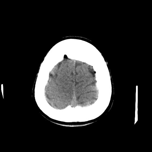 Cerebral arteriovenous malformation (Radiopaedia 28518-28759 Axial non-contrast 65).jpg