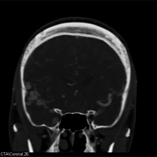 File:Cerebral arteriovenous malformation (Radiopaedia 28518-28759 C 26).jpg