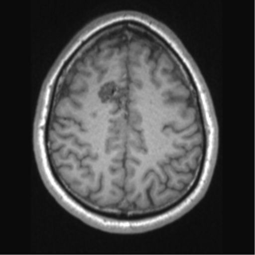 Cerebral arteriovenous malformation (Radiopaedia 39259-41506 Axial T1 57).png