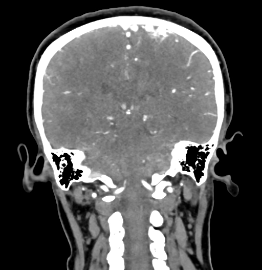 Cerebral arteriovenous malformation (Radiopaedia 73830-84645 C 63).jpg