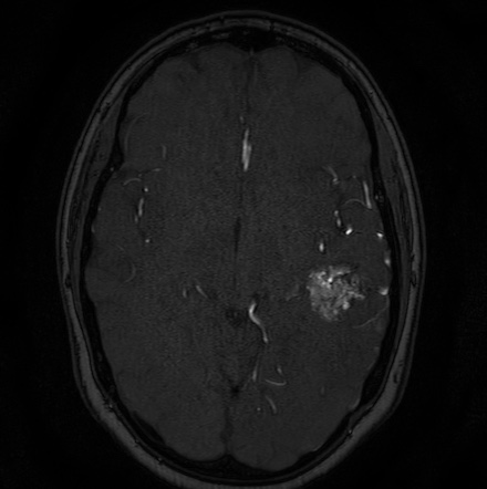 Cerebral arteriovenous malformation (Radiopaedia 74411-85654 Axial MRA 64).jpg