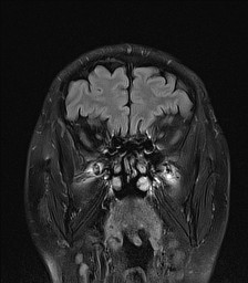 File:Cerebral arteriovenous malformation (Radiopaedia 84015-99245 Coronal FLAIR 8).jpg