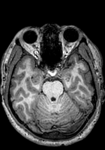 Cerebral arteriovenous malformation at posterior body of corpus callosum (Radiopaedia 74111-84925 Axial T1 209).jpg