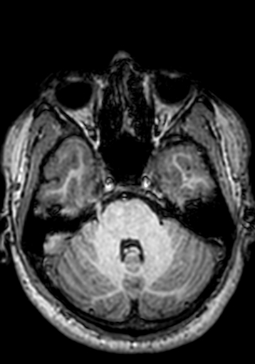 Cerebral arteriovenous malformation at posterior body of corpus callosum (Radiopaedia 74111-84925 Axial T1 229).jpg