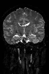 Cerebral arteriovenous malformation at posterior body of corpus callosum (Radiopaedia 74111-84925 Coronal T2 88).jpg