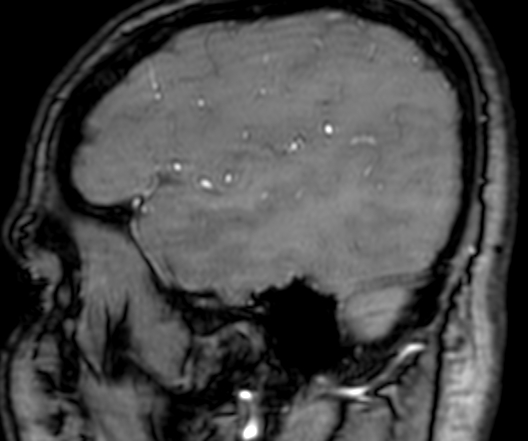 Cerebral arteriovenous malformation at posterior body of corpus callosum (Radiopaedia 74111-84925 J 49).jpg