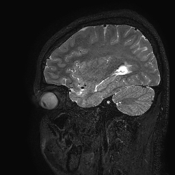Cerebral arteriovenous malformation at posterior body of corpus callosum (Radiopaedia 74111-84925 Sagittal T2 32).jpg