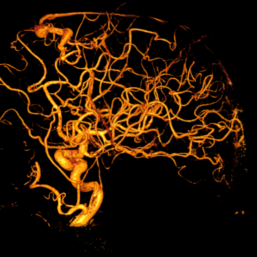 Cerebral arteriovenous malformation with lobar hemorrhage (Radiopaedia 44725-48513 Lateral 46).png