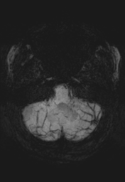 File:Cerebral cavernoma and development venous anomaly (Radiopaedia 37603-39482 Axial SWI MIP 7).png
