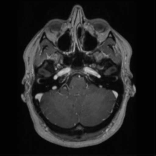 Cerebral cavernoma and development venous anomaly (Radiopaedia 37603-39482 Axial T1 C+ 18).png