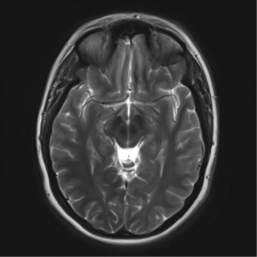 File:Cerebral cavernoma and development venous anomaly (Radiopaedia 37603-39482 Axial T2 10).png