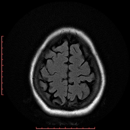 File:Cerebral cavernous malformation (Radiopaedia 26177-26306 FLAIR 18).jpg
