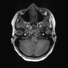 File:Cerebral cavernous venous malformation (Radiopaedia 70008-80021 Axial T1 12).jpg