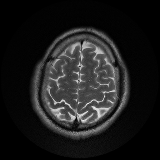 File:Cerebral cavernous venous malformation (Zabramski type II) (Radiopaedia 85511-101198 Axial T2 26).jpg