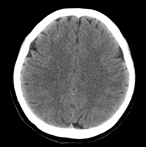 File:Cerebral cavernous venous malformations (Radiopaedia 48117-52945 Axial non-contrast 22).png