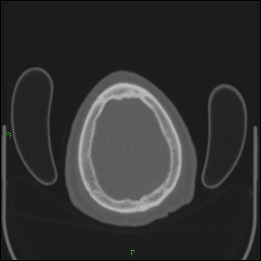 Cerebral contusions (Radiopaedia 33868-35039 Axial bone window 200).jpg