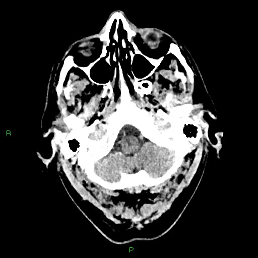 Cerebral contusions (Radiopaedia 33868-35039 Axial non-contrast 22).jpg