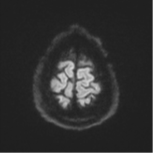 Cerebral embolic infarcts (embolic shower) (Radiopaedia 57395-64342 Axial DWI 69).png