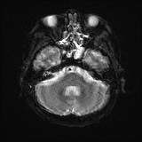 Cerebral embolic infarcts (embolic shower) (Radiopaedia 72391-82921 Axial DWI 7).jpg