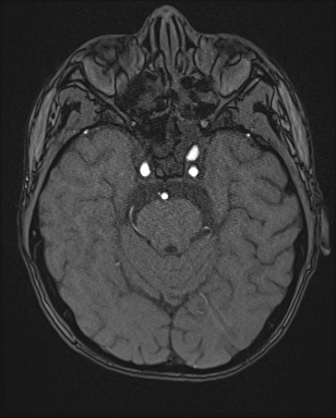 Cerebral embolic infarcts (embolic shower) (Radiopaedia 72391-82921 Axial MRA 45).jpg