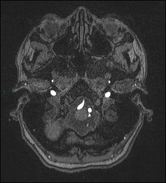 Cerebral fat embolism (Radiopaedia 35022-36525 Axial TOF 19).jpg