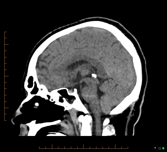 Cerebral fat embolism (Radiopaedia 85521-101220 B 28).jpg