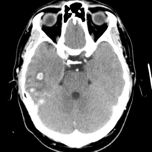 File:Cerebral hemorrhage secondary to arteriovenous malformation (Radiopaedia 33497-34561 B 18).png