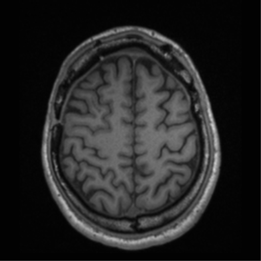 Cerebral hemorrhagic contusions- temporal evolution (Radiopaedia 40224-42757 Axial T1 62).png