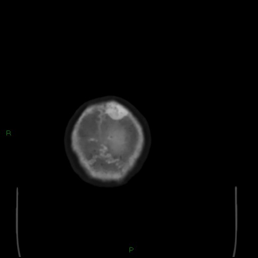 Cerebral metastases - breast primary (Radiopaedia 77653-89857 Axial bone window 116).jpg
