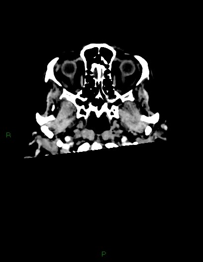 Cerebral metastases - ependymal and parenchymal (Radiopaedia 79877-93131 Axial C+ delayed 3).jpg