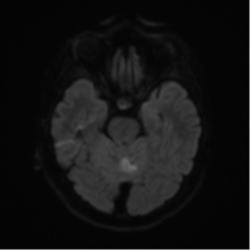 Cerebral metastases mimicking abscesses (Radiopaedia 45841-50131 Axial DWI 39).png