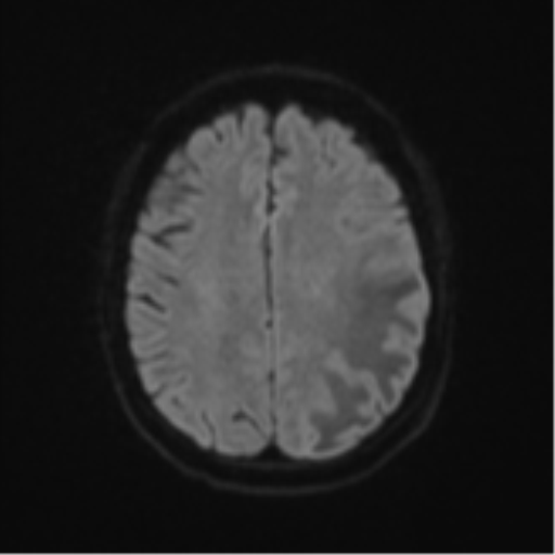 Cerebral metastasis (Radiopaedia 46744-51248 Axial DWI 47).png