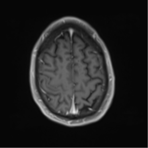 Cerebral metastasis - melanoma (Radiopaedia 54718-60954 Axial T1 C+ fat sat 44).png