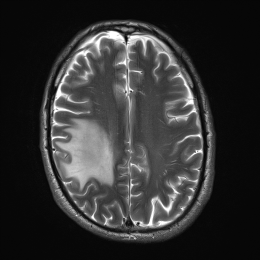 File:Cerebral metastasis - melanoma (Radiopaedia 54718-60954 Axial T2 21).png