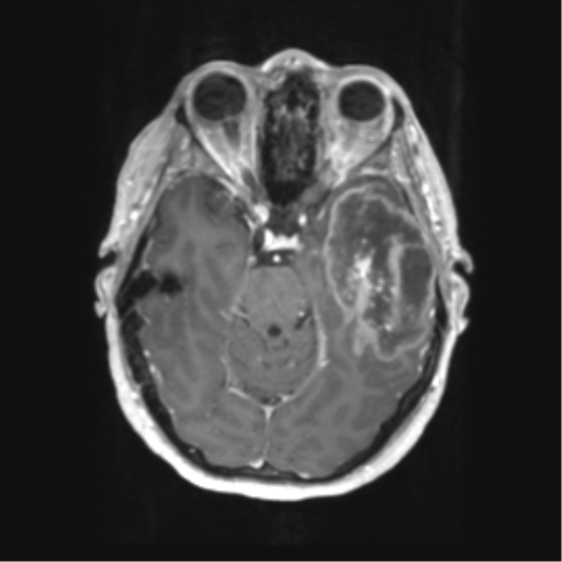 Cerebral metastasis mimicking glioblastoma (Radiopaedia 69155-78937 Axial T1 C+ 20).png