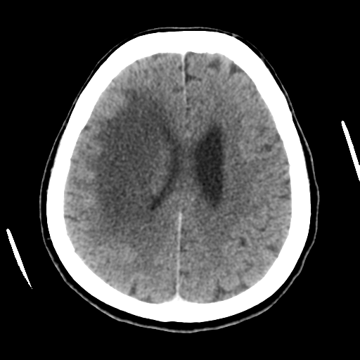 Cerebral metastasis to basal ganglia (Radiopaedia 81568-95412 Axial C+ delayed 40).png