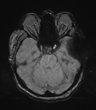File:Cerebral metastasis to basal ganglia (Radiopaedia 81568-95413 Axial SWI magnitude 25).png